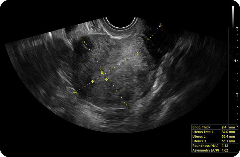 Uterus saggital