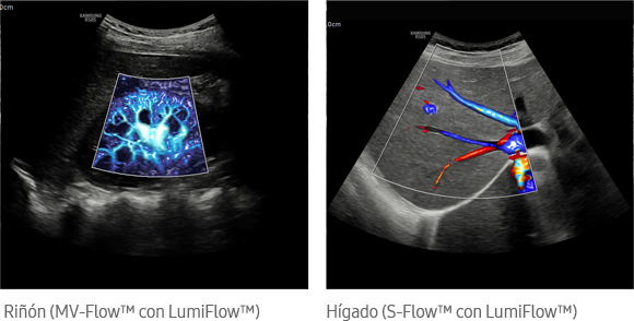 Riñón (MV-Flow™ con LumiFlow™), Hígado (S-Flow™ con LumiFlow™)