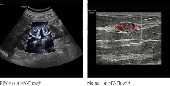 Riñón con MV-Flow™, Mama con MV-Flow™