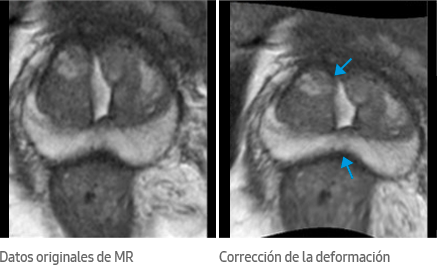 Datos originales de MR, Corrección de la deformación