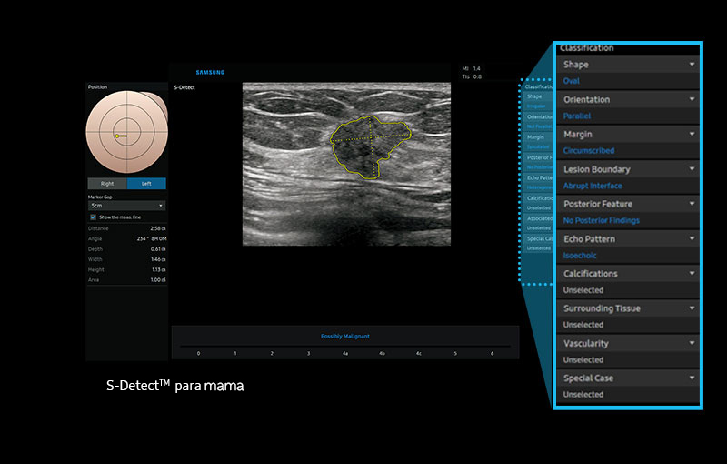 S-Detect™ para la mama