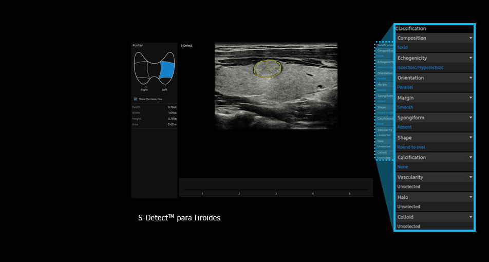 S-Detect™ para tiroides