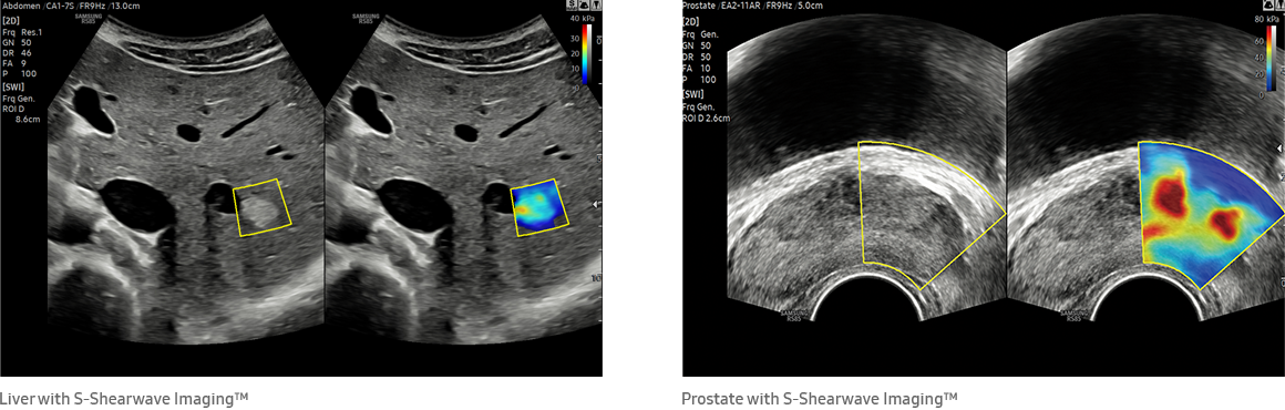 Liver with S-Shearwave Imaging™, Prostate with S-Shearwave Imaging™