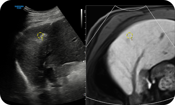 S-Fusion™ : Performing fusion ultrasound fusion biopsies