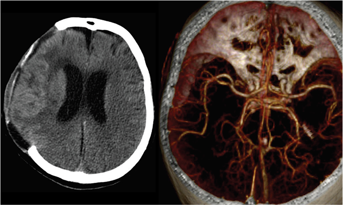 Cranial neurosurgery Sample