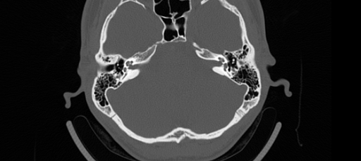 BodyTom-64-Bilateral-IAC