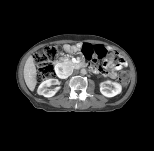 BodyTom-Abdomen-Pancreatic-Mass