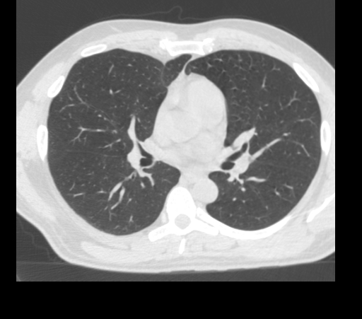 BodyTom-Chest-Lung-Window