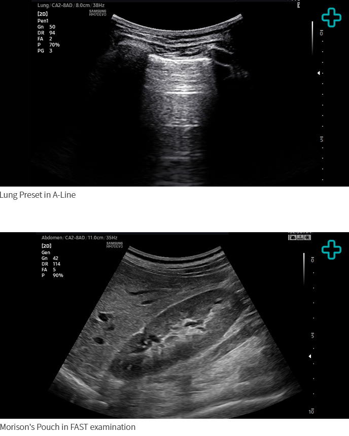 Lung Preset in A-Line, Morison's Pouch in FAST examination