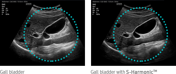 Gall bladder with S-HarmonicTM