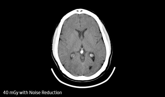 S-Detect™ for Thyroid Sample