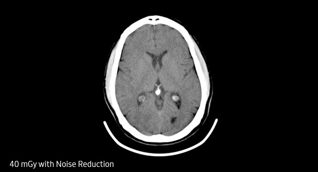 S-Detect™ for Thyroid Sample