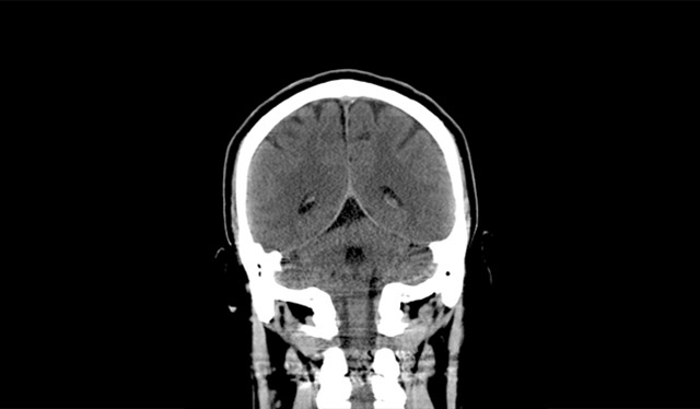 S-Detect™ for Thyroid Sample