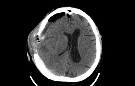Adult-Brain-Post-Surgery
