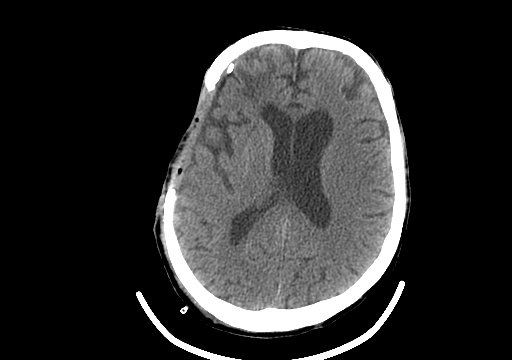 Adult-Post-Surgical-Craniotomy