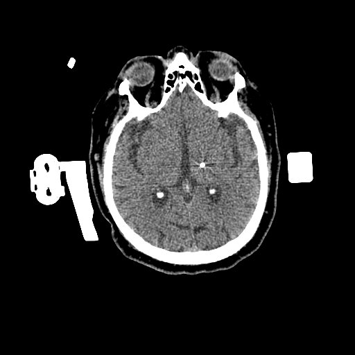 1.25mm-Deep-Brain-Stimulation-Brain-Window-1-Electrodes