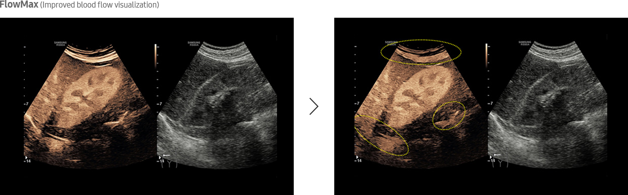 FlowMax (Improved blood flow visualization)
