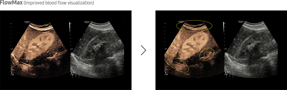 FlowMax (Improved blood flow visualization)