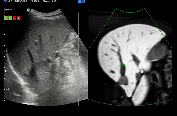 S-Detect™ for Breast