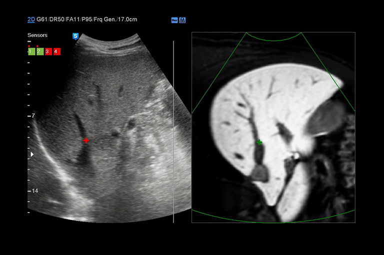 S-Detect™ for Breast