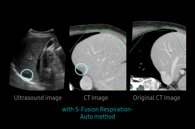 S-Detect™ for Thyroid