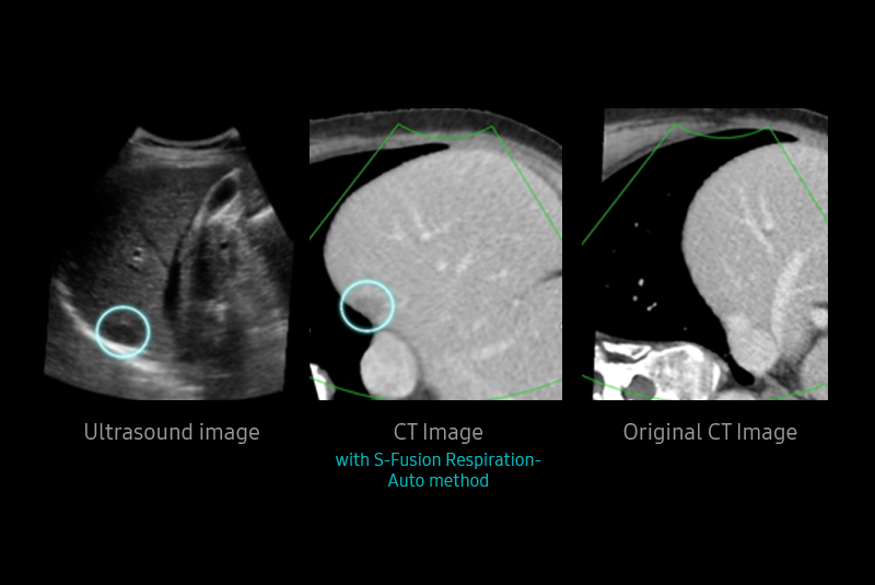 S-Detect™ for Thyroid