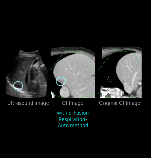 S-Detect™ for Thyroid