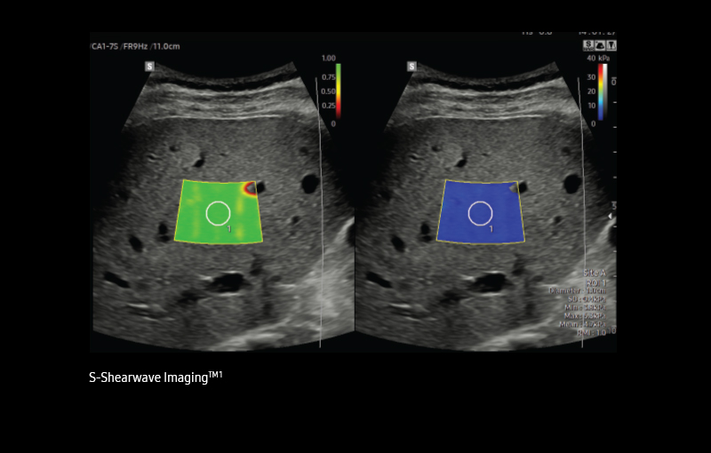 ultrasound for liver EzHRI™ ¹