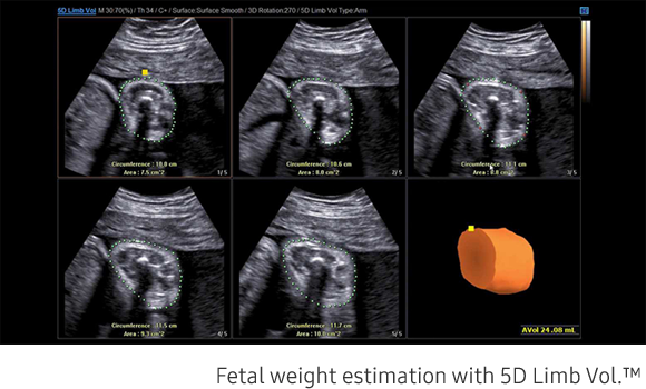 Fetal weight estimation with 5D Limb Vol.™