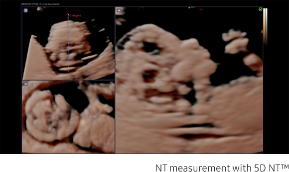 Fetal brain measurement with 5D CNS+™