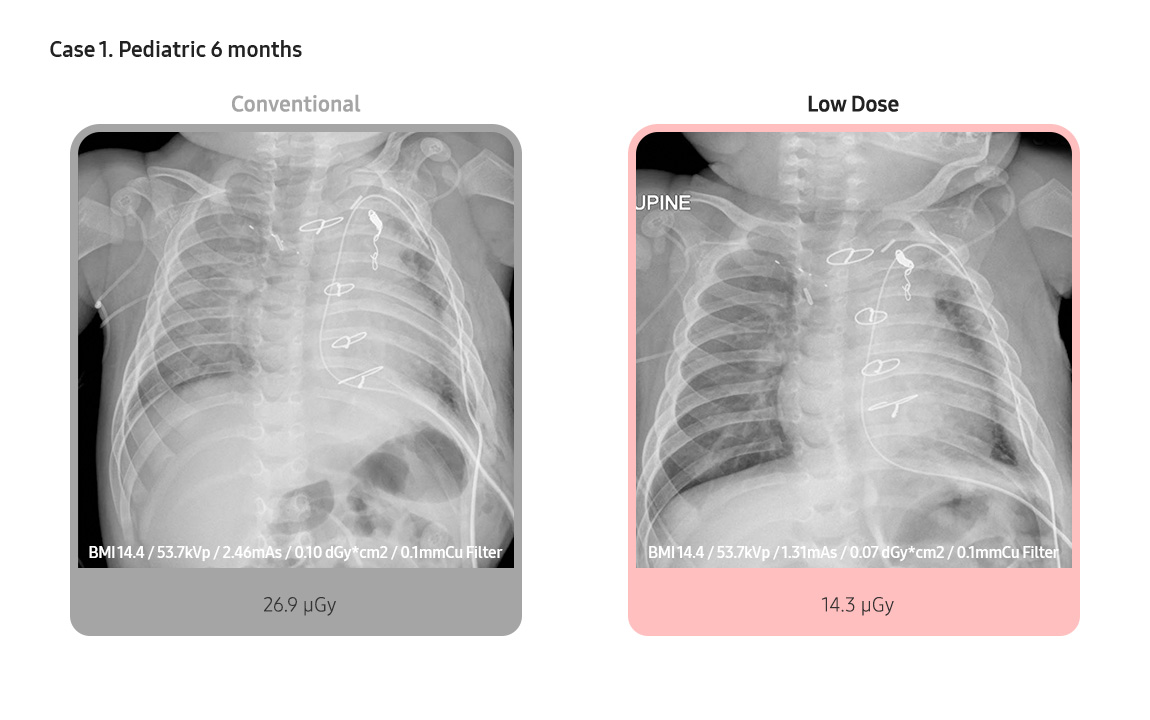 Case 1. Pediatric 6 months