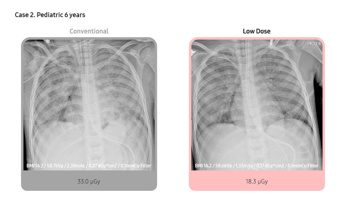 Case 2. Pediatric 6 years