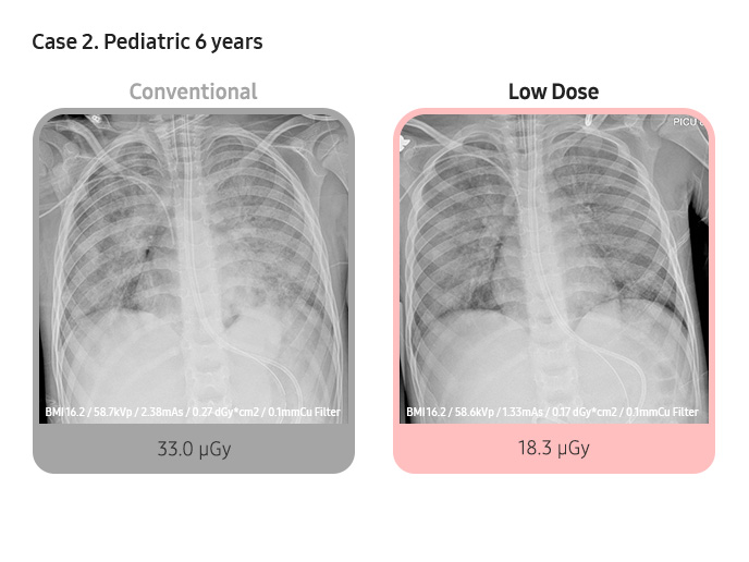 Case 2. Pediatric 6 years