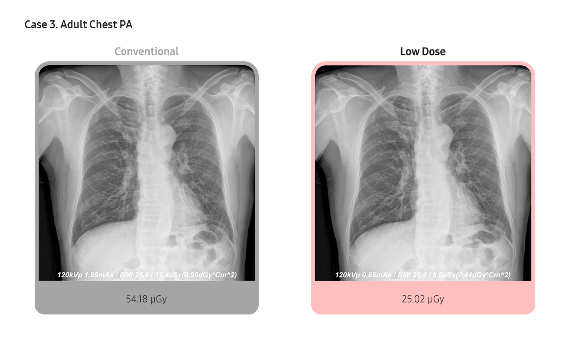 Case 3. Adult Chest PA