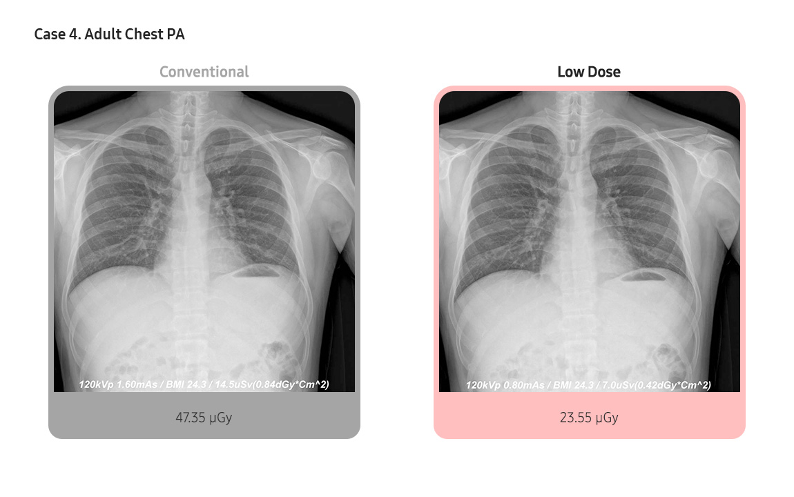 Case 4. Adult Chest PA