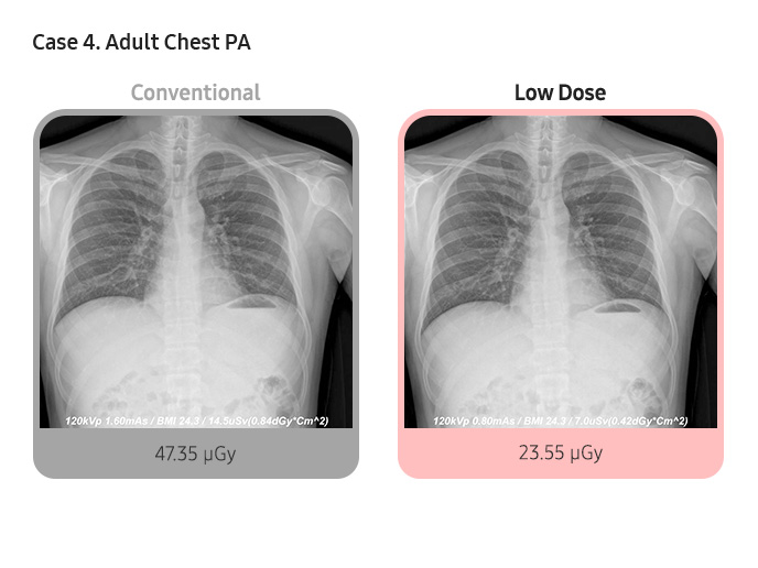 Case 4. Adult Chest PA