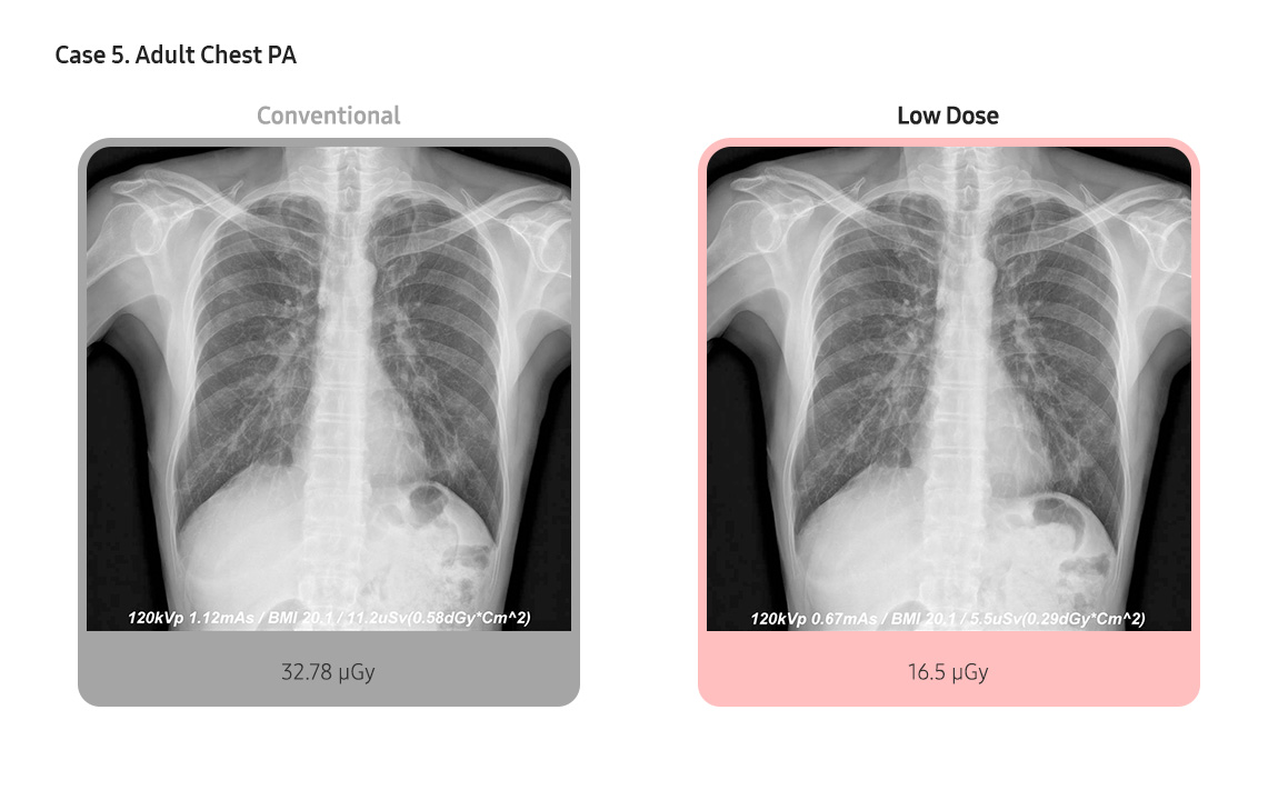 Case 5. Adult Chest PA