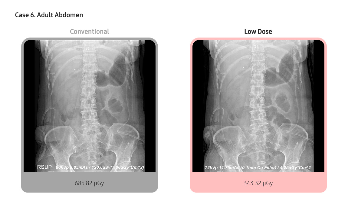 Case 6. Adult Abdomen