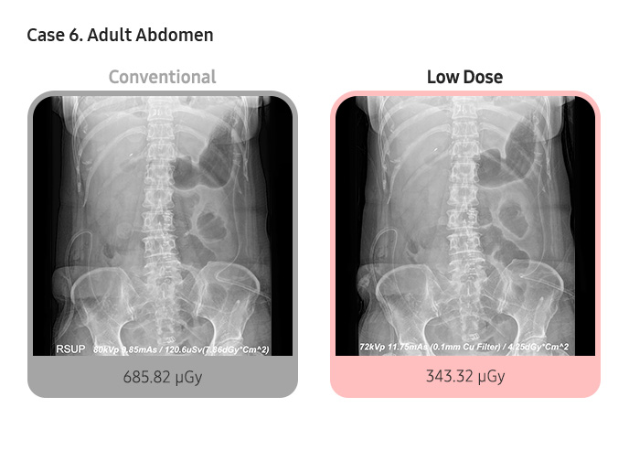 Case 6. Adult Abdomen