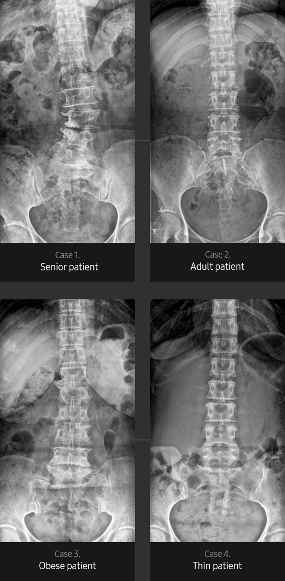 Lumbar Spine AP Sample