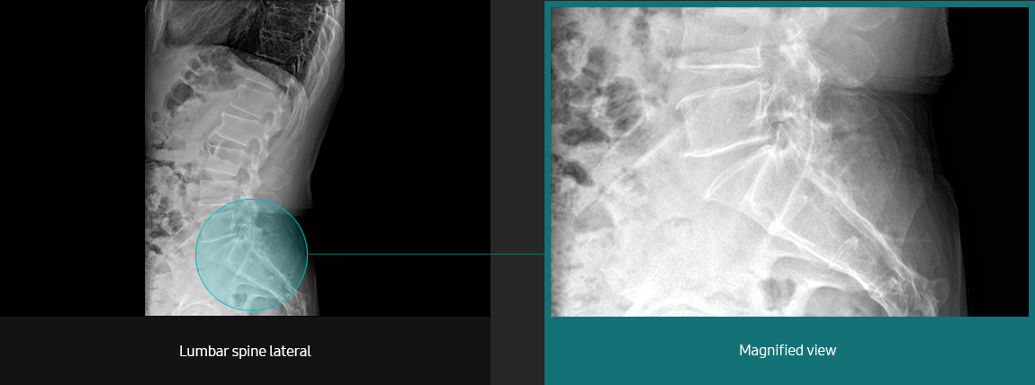 Lumbar Spine Sample