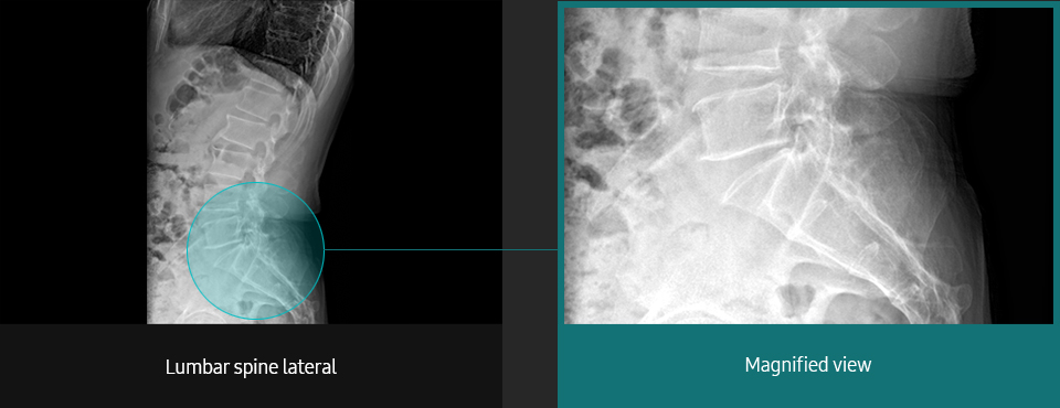 Lumbar Spine Sample