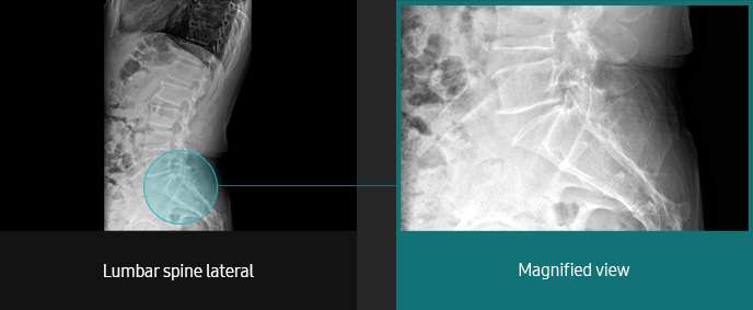 Lumbar Spine Sample