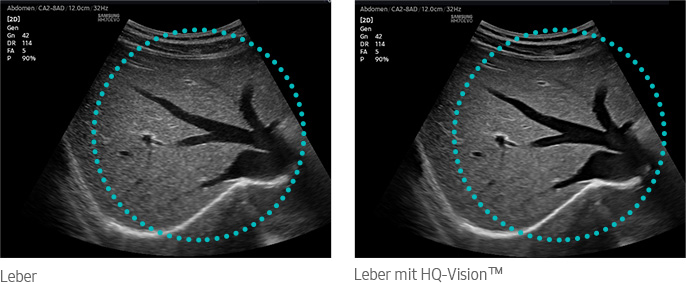 Leber, Leber mit HQ-Vision™
