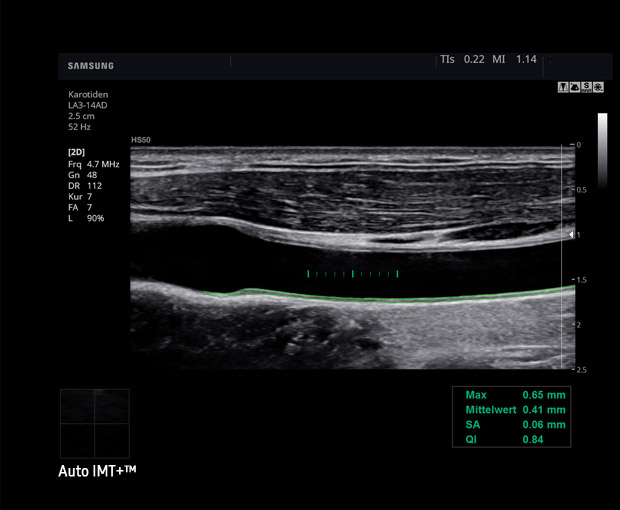 S-Vue transducer  Sample