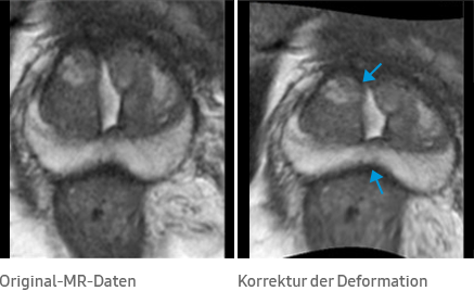 Original-MR-Daten, Korrektur der Deformation