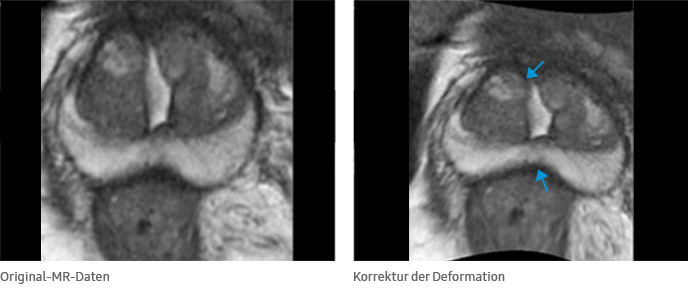 Original-MR-Daten, Korrektur der Deformation