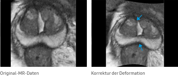 Original-MR-Daten, Korrektur der Deformation