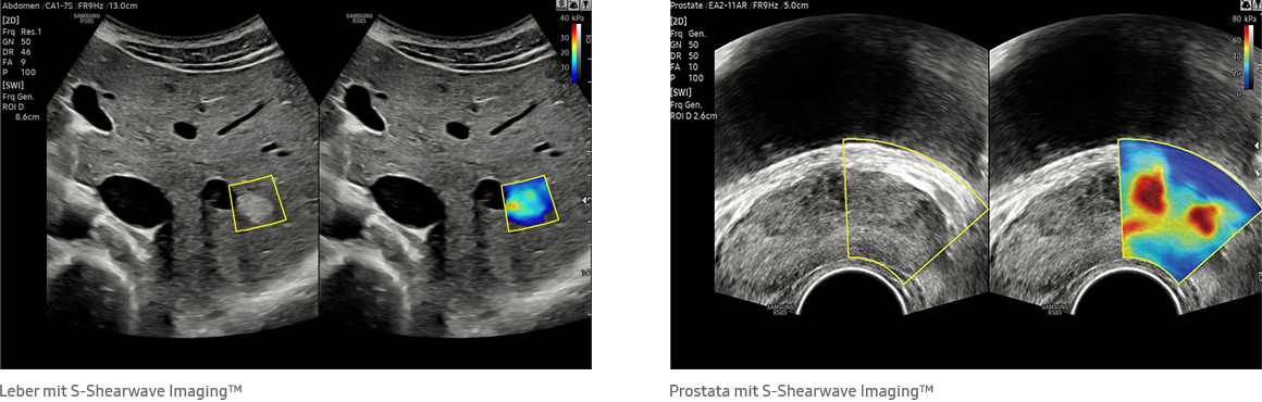Leber mit S-Shearwave Imaging™, Prostata mit S-Shearwave Imaging™
