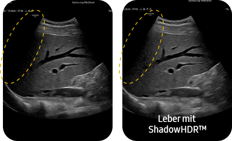 Liver Dome with ShadowHDR™